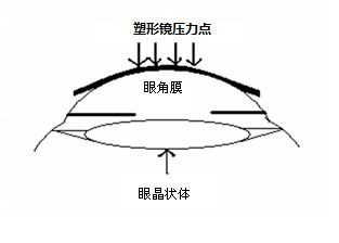 角膜塑形用硬性透氣接觸鏡說明書編寫指導原則（2020年修訂版）（2020年第47號）(圖1)