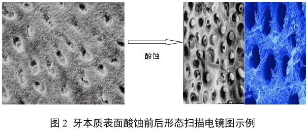 牙科用磷酸酸蝕劑注冊(cè)審查指導(dǎo)原則（2022年第41號(hào)）(圖2)