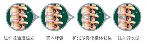 骨水泥套管組件注冊技術(shù)審查指導(dǎo)原則（2018年第107號）(圖1)